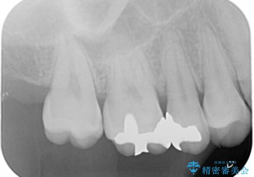 銀の詰め物がある2歯を白くしたい。の治療前