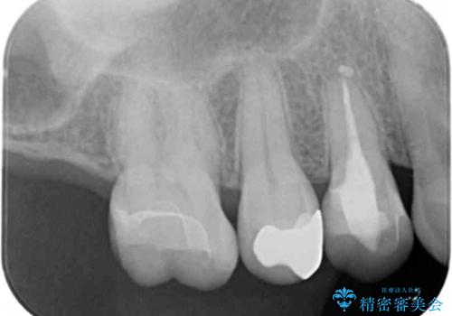 銀歯を白くしたいの治療前