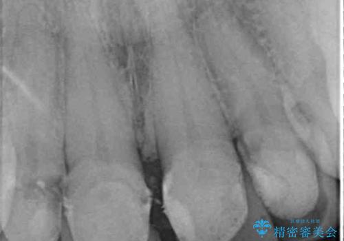 ひどすぎる前歯の仮歯 オールセラミッククラウンで自然な前歯にの治療前