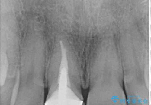 白すぎる前歯と虫歯の奥歯 セラミック治療の治療前