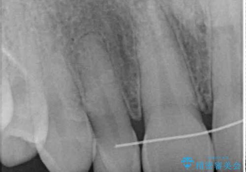 境目が目立つラミネートベニアを作り替えの治療前