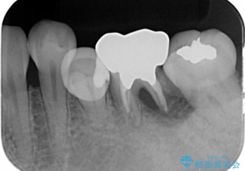奥歯が割れた　インプラントは不向き　部分矯正後、ブリッジで治療の治療前