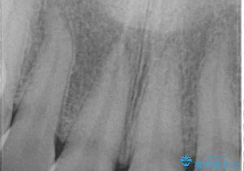 歯ぐきにできものができた 前歯の色調改善の治療前