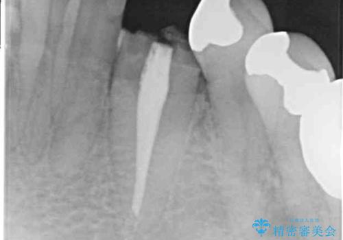 抜歯と言われた歯　部分矯正と歯周外科処置で抜かずに保存の治療前