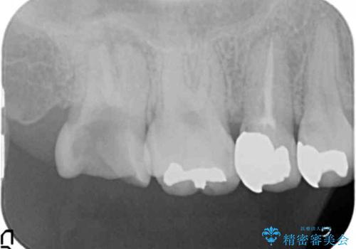 放置した虫歯を外科を行い抜歯を回避の治療前