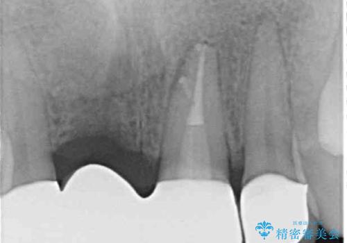 転んでぶつけて抜歯 前歯のオールセラミックブリッジの治療後