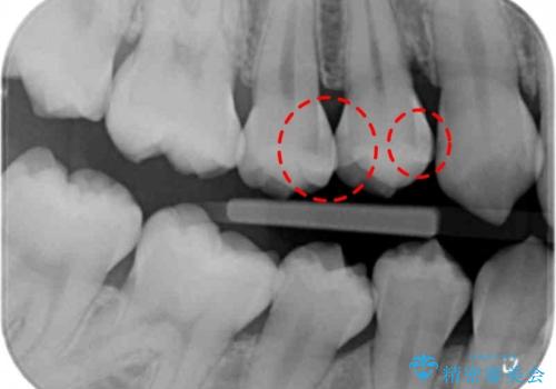 歯と歯の間の虫歯 セラミックインレーでの治療