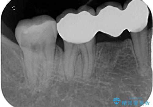 前歯のデコボコと奥歯の咬み合わせをインビザラインで改善の治療後