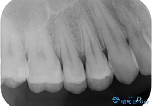 銀の詰め物がある2歯を白くしたい。の治療後