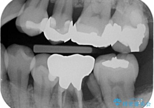 奥歯が割れた インプラントは不向き 部分矯正後、ブリッジで治療の治療前