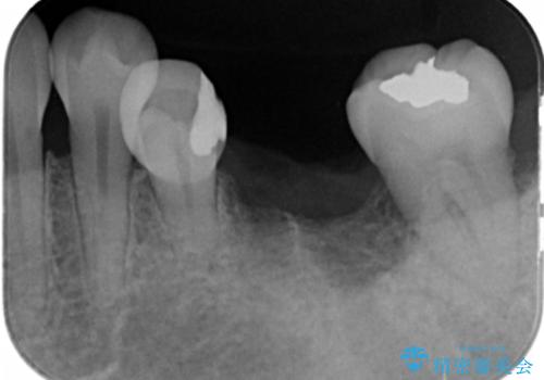 奥歯が割れた インプラントは不向き 部分矯正後、ブリッジで治療の治療中