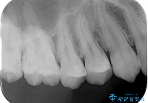 歯と歯の間の虫歯 セラミックインレーでの治療の治療後