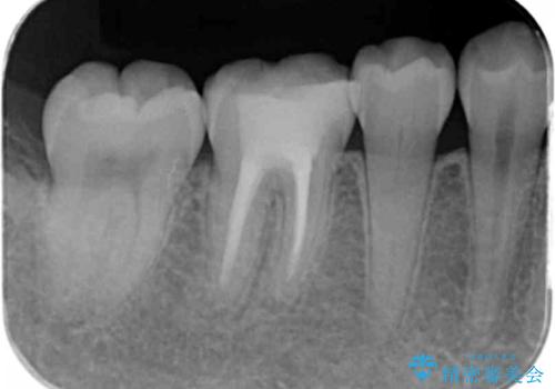 樹脂をセラミックにしたい ジルコニアクラウンでの治療の治療前