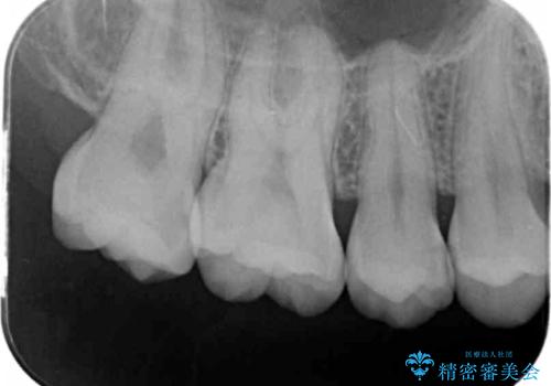 歯と歯の間の虫歯 セラミックインレーでの治療の治療前
