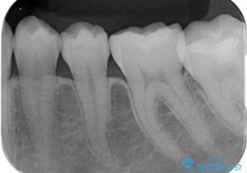 メタルインレーをセラミックインレーに。の治療後