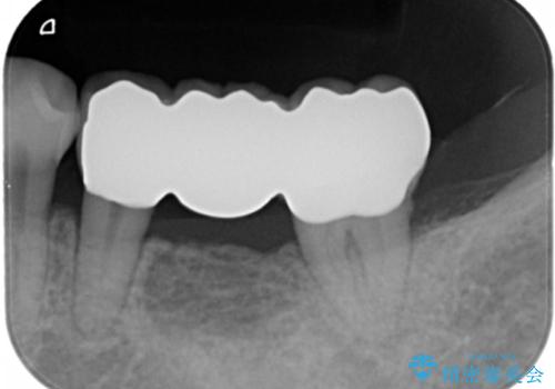 奥歯が割れた　インプラントは不向き　部分矯正後、ブリッジで治療の治療後