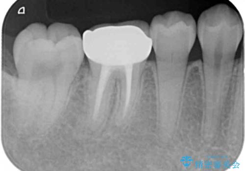 樹脂をセラミックにしたい ジルコニアクラウンでの治療の治療後