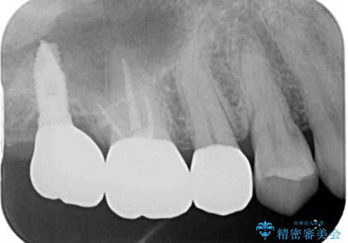奥歯のセラミックがすぐに壊れる　欠損した奥歯へのインプラント治療の治療後