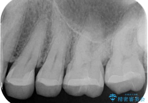 銀歯と樹脂の詰め物のやり替え セラミックインレーでの治療の治療後