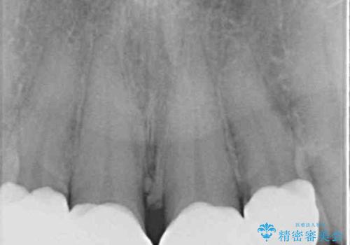 ひどすぎる前歯の仮歯 オールセラミッククラウンで自然な前歯にの治療後