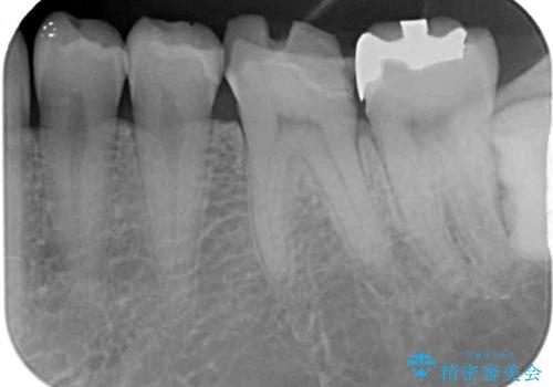 白すぎる前歯と虫歯の奥歯 セラミック治療の治療前