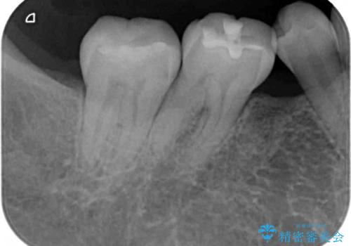 前歯のデコボコと奥歯の咬み合わせをインビザラインで改善の治療前