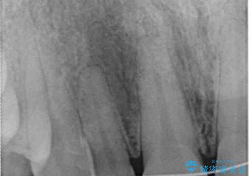 境目が目立つラミネートベニアを作り替えの治療後