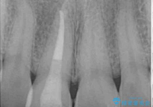 歯ぐきにできものができた 前歯の色調改善の治療中