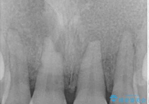 転んでぶつけて抜歯 前歯のオールセラミックブリッジの治療前