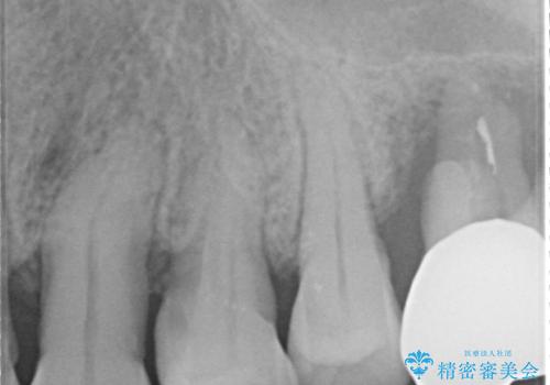 強い咬合力に対抗する歯周補綴の治療前
