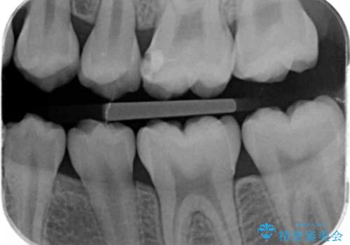 他院で治療した部分の気泡 セラミックインレーでの修復の治療前