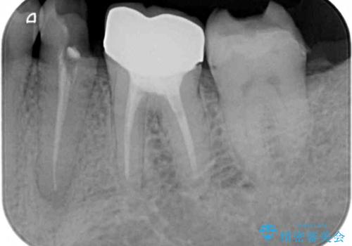 詰め物の外れてしまった奥歯 部分矯正で歯列を整えてから補綴治療の治療前