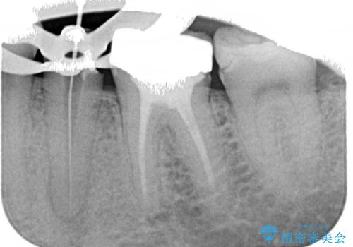 詰め物の外れてしまった奥歯　部分矯正で歯列を整えてから補綴治療の治療中