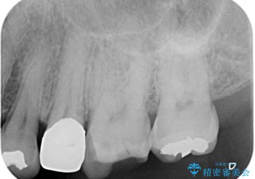 詰め物の外れてしまった奥歯　部分矯正で歯列を整えてから補綴治療の治療前