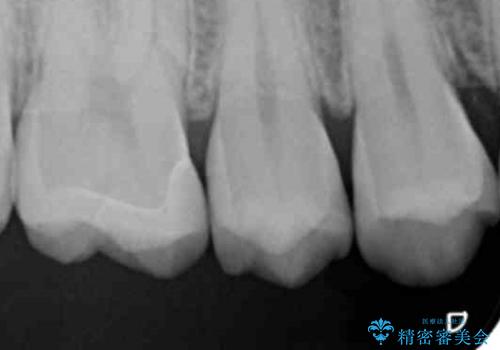 歯と歯の間の虫歯 セラミックインレーでの治療の治療後