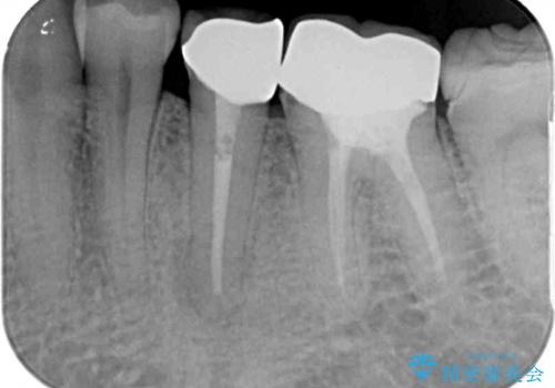 詰め物の外れてしまった奥歯　部分矯正で歯列を整えてから補綴治療の治療後
