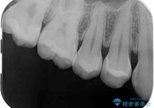 歯と歯の間の虫歯 セラミックインレーでの治療の治療後