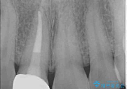 歯ぐきにできものができた 前歯の色調改善の治療後