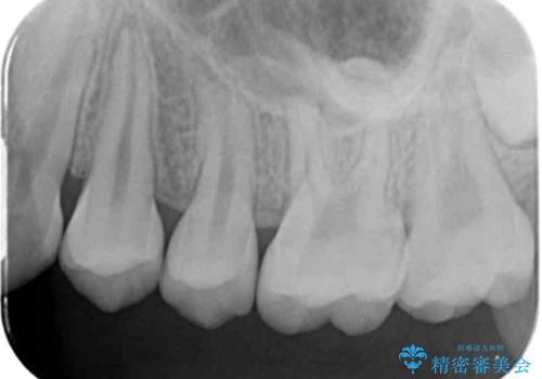 他院で治療した部分の気泡 セラミックインレーでの修復の治療後