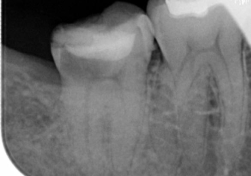 歯科でトラウマ 怖くて行っていなかったが、今度こそきちんと治療したいの治療前