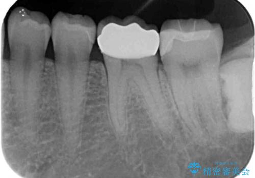 白すぎる前歯と虫歯の奥歯 セラミック治療の治療後