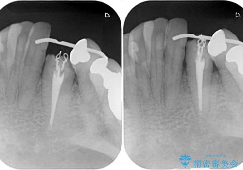 抜歯と言われた歯　部分矯正と歯周外科処置で抜かずに保存の治療中