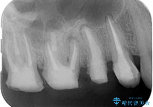 根管治療・歯周外科を行い歯を残した、複合的虫歯治療の治療中