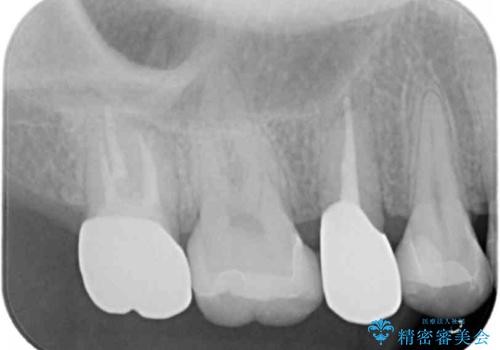 放置した虫歯を外科を行い抜歯を回避の治療後