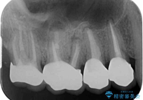 根管治療・歯周外科を行い歯を残した、複合的虫歯治療の治療後