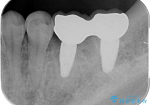 歯科でトラウマ 怖くて行っていなかったが、今度こそきちんと治療したいの治療後