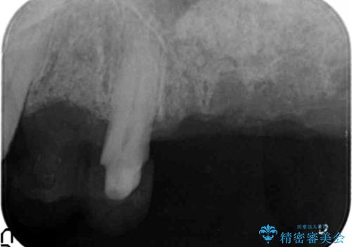 骨の造成を行った上顎インプラント治療の治療中