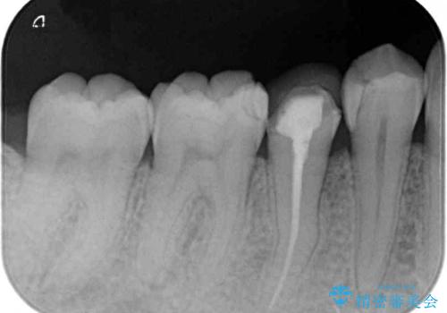 欠けてしまったプラスチック オールセラミッククラウンで土台の歯を守るの治療前