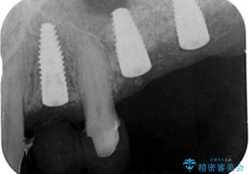 骨の造成を行った上顎インプラント治療の治療中