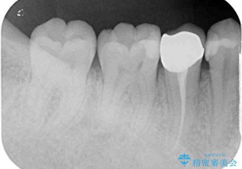 欠けてしまったプラスチック オールセラミッククラウンで土台の歯を守るの治療後